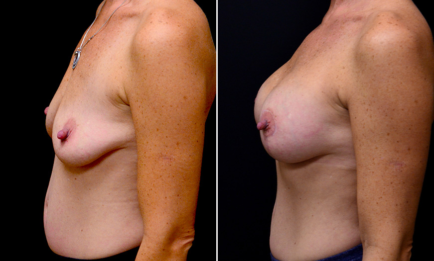 Before And After Breast Implant Surgery