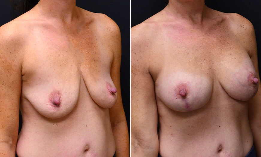 Breast Implant Surgery Before & After