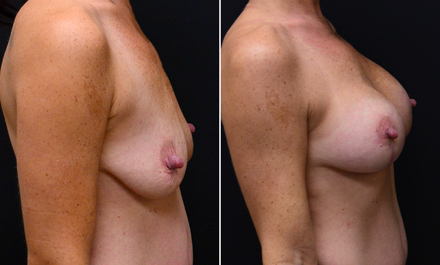 Breast Implant Surgery Before And After