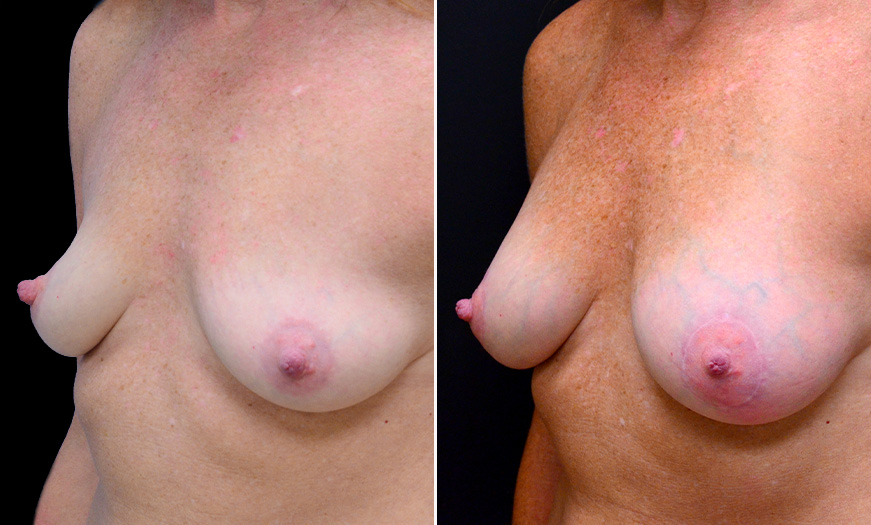 Breast Implants Treatment Results