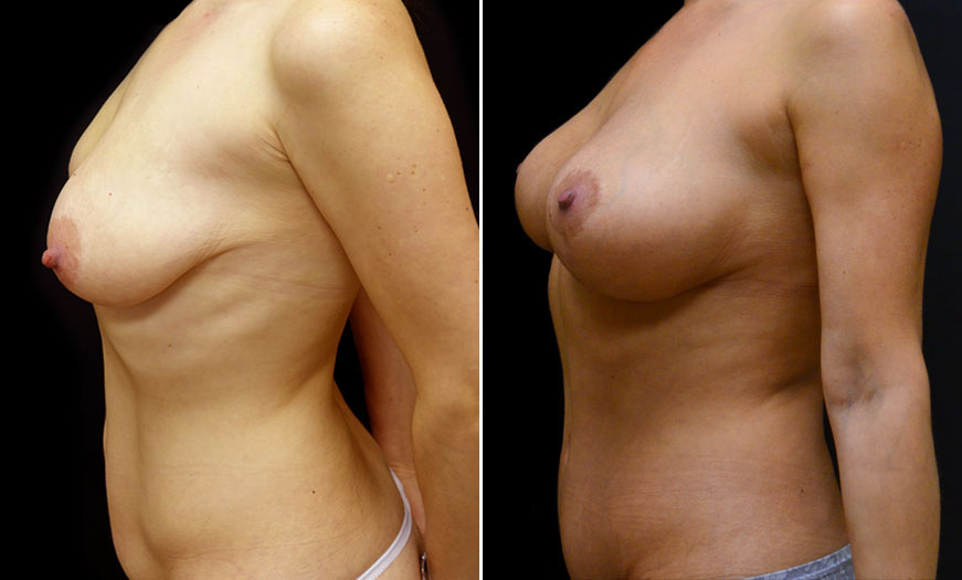 Breast Implants Surgery Before & After