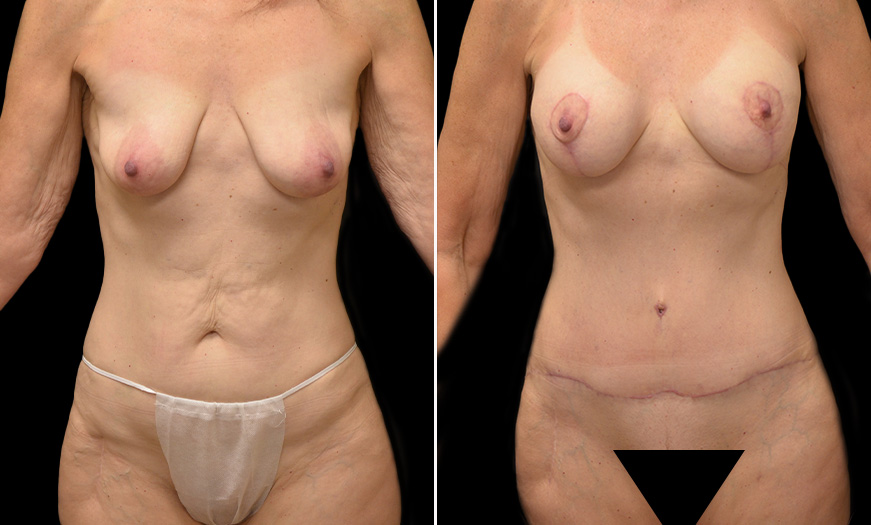 Tummy Tuck Before & After NJ
