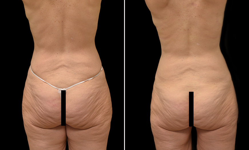 Tummy Tuck Before & After In NJ