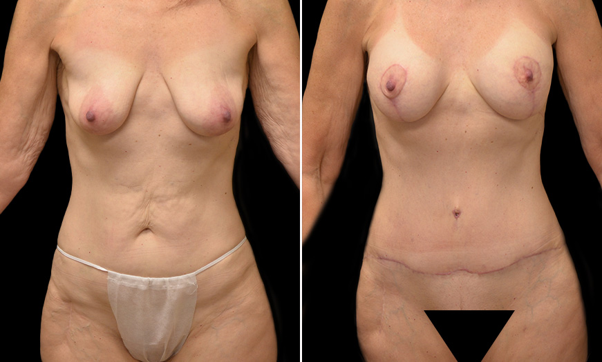 Breast Augmentation Results