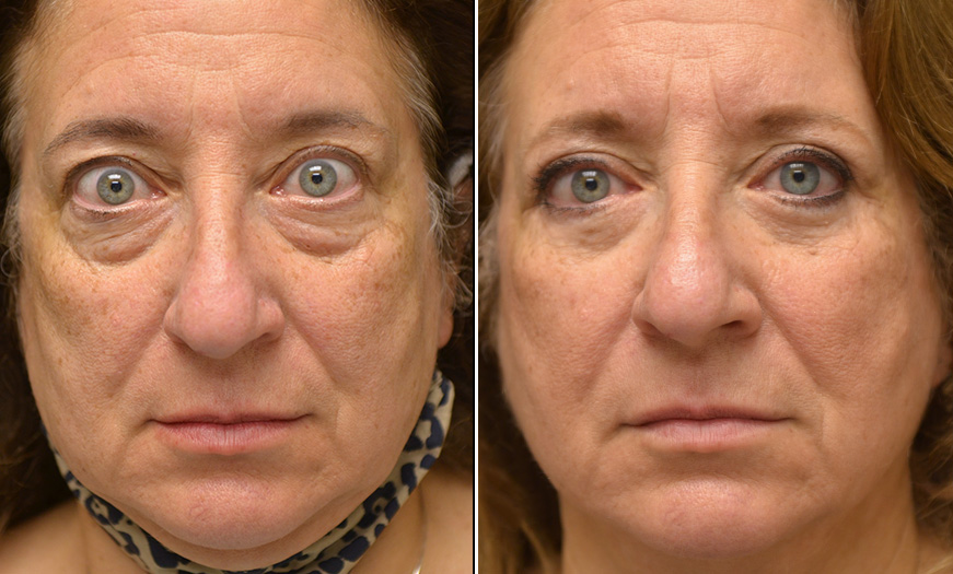 Bilateral Upper And Lower Blepharoplasty