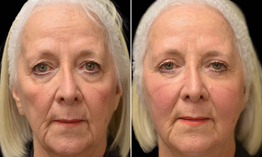 Face Lift Before & After