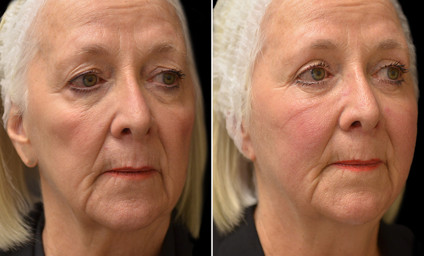 Face Lift Before & After NJ