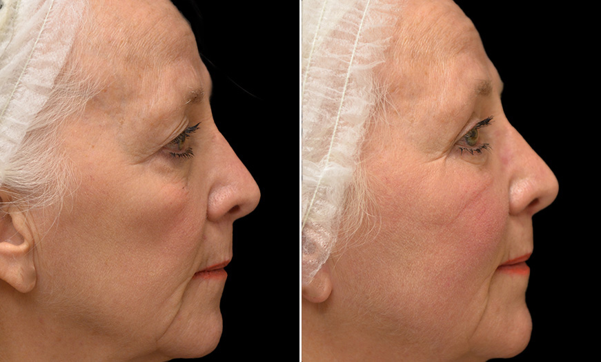 Face Lift Before & After New Jersey
