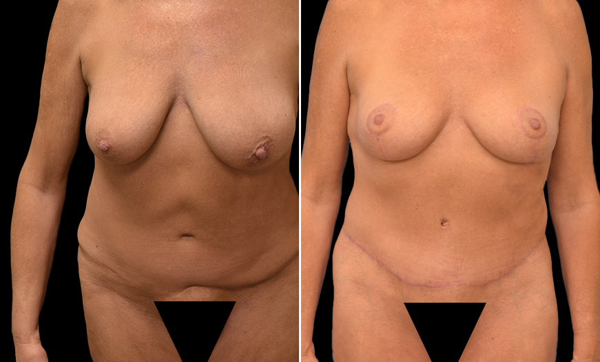 Breast Reduction Results
