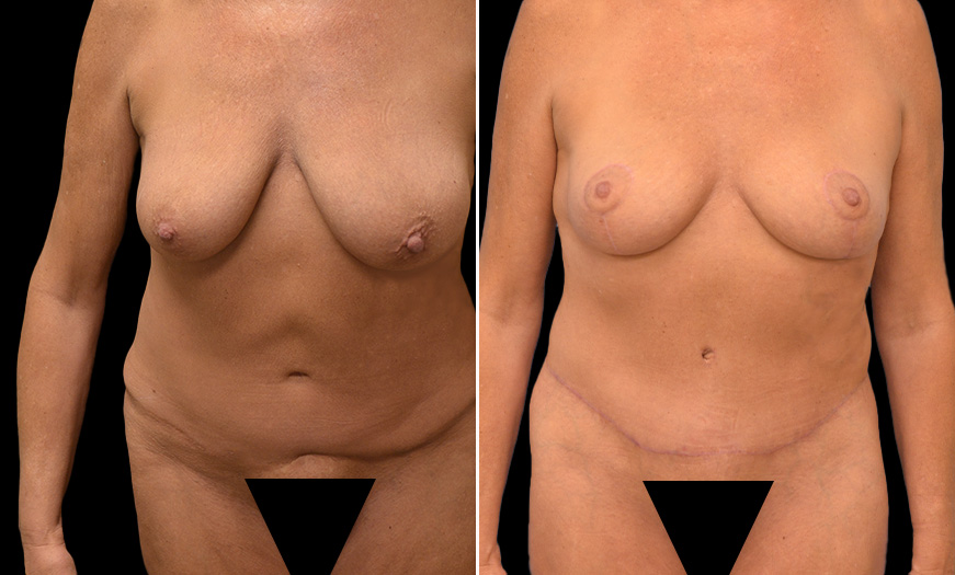 Body Lift Before & After