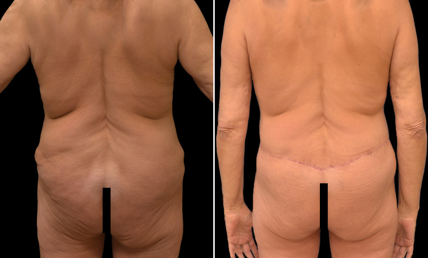 Tummy Tuck Surgery Results NJ