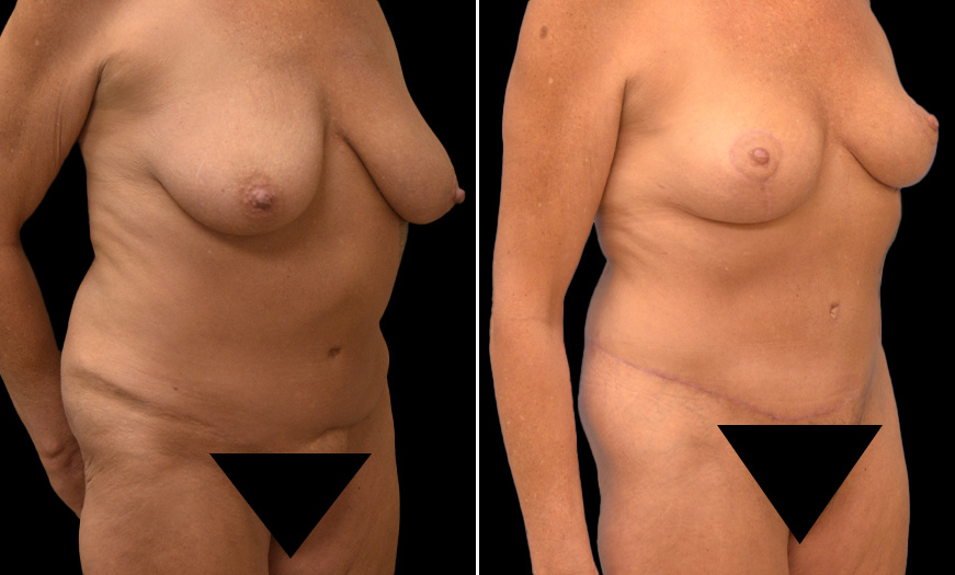 Tummy Tuck Surgery Results New Jersey