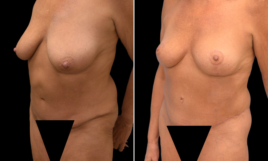 Tummy Tuck Surgery Before & After