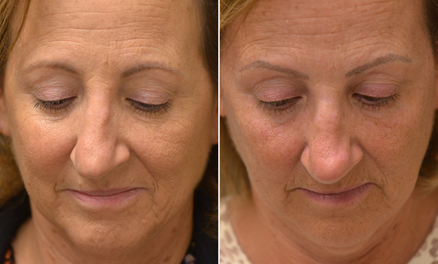 Rhinoplasty Surgery Results In NJ