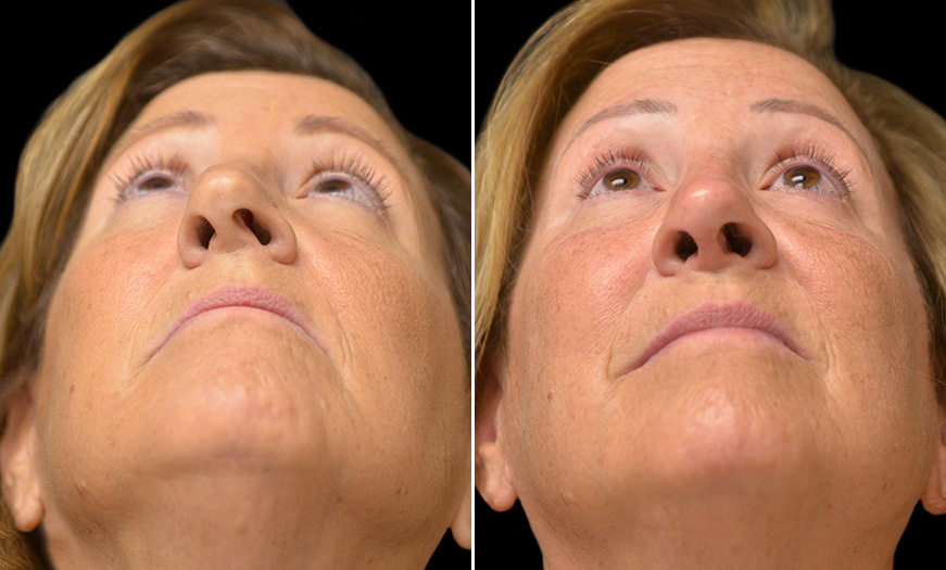 Rhinoplasty Surgery Results In New Jersey