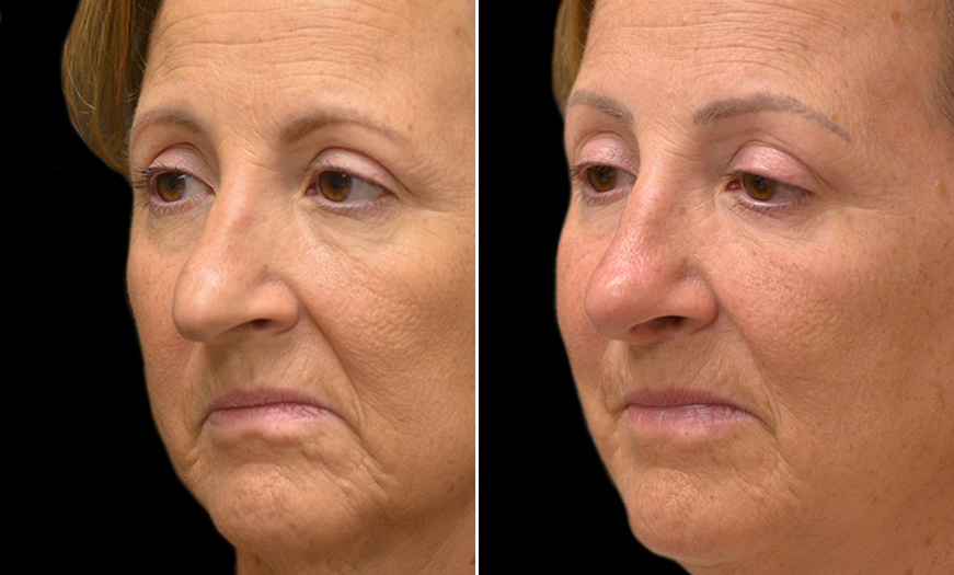 Rhinoplasty Surgery Results NJ