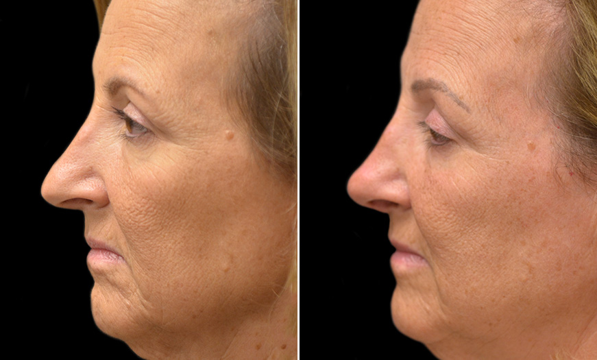 Rhinoplasty Surgery Results New Jersey