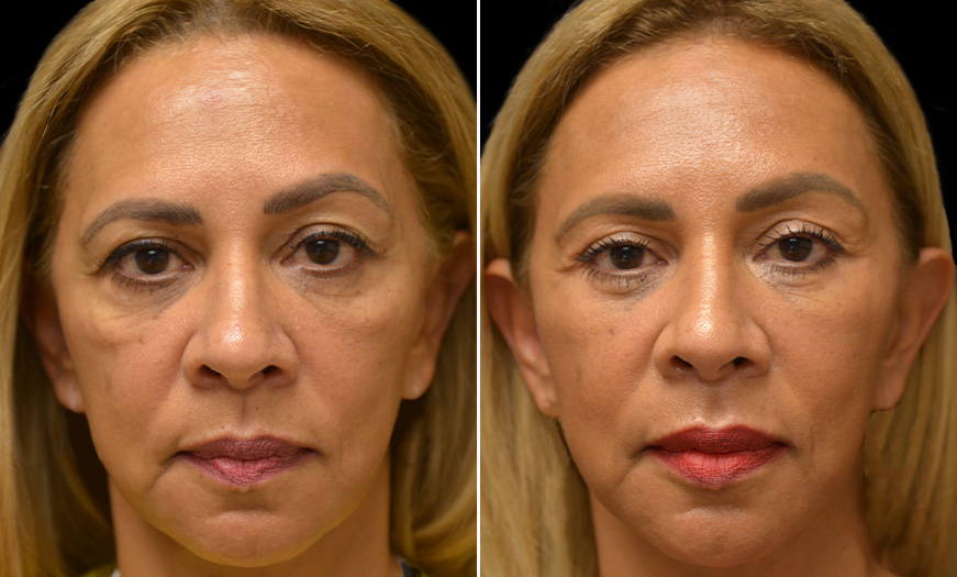 Festoon Correction And Facelift In NJ