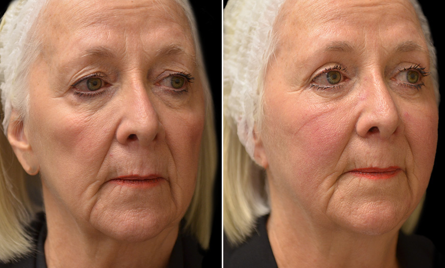 Blepharoplasty, Festoon Correction, & Face Lift Results NJ