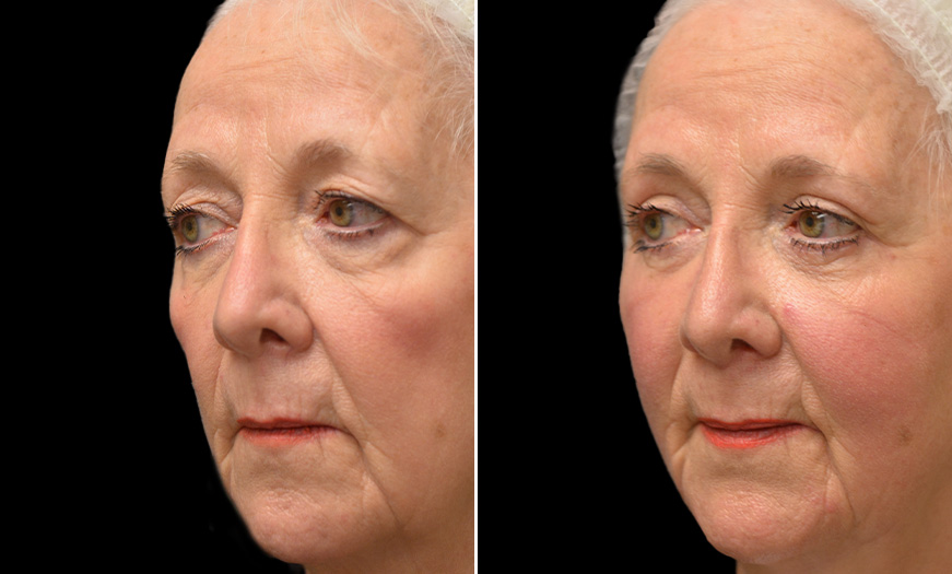 Blepharoplasty, Festoon Correction, & Face Lift Results In NJ