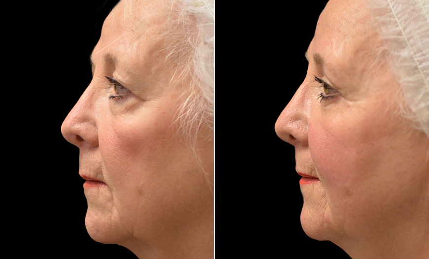 Blepharoplasty, Festoon Correction, & Face Lift Results In New Jersey