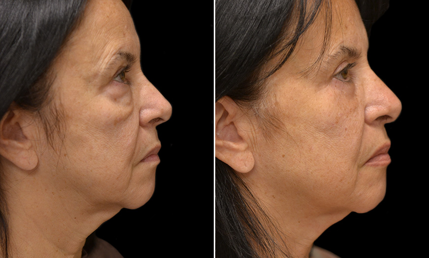 Eyelid Surgery, Festoon Correction, & Midface Lift Results New Jersey