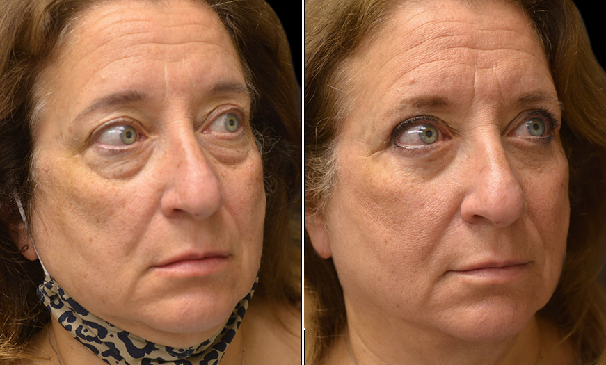 Blepharoplasty & Midface Lift Results NJ