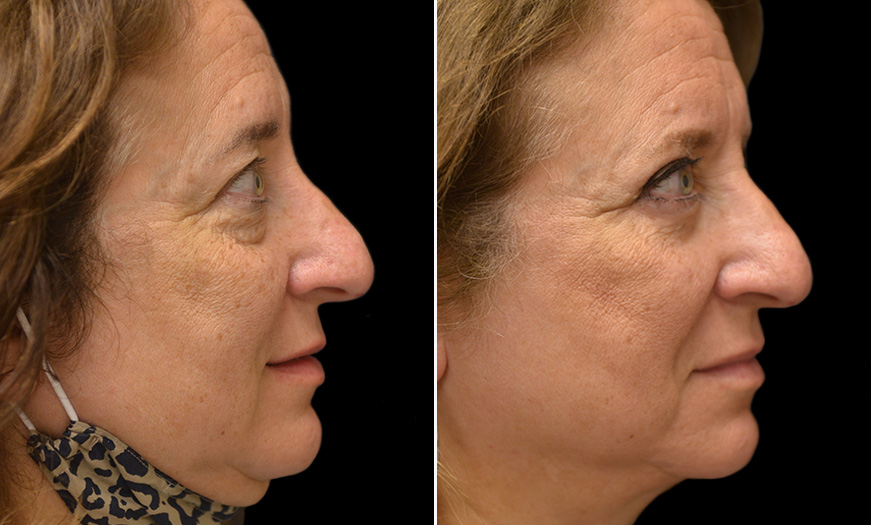 Blepharoplasty & Midface Lift New Jersey Results 