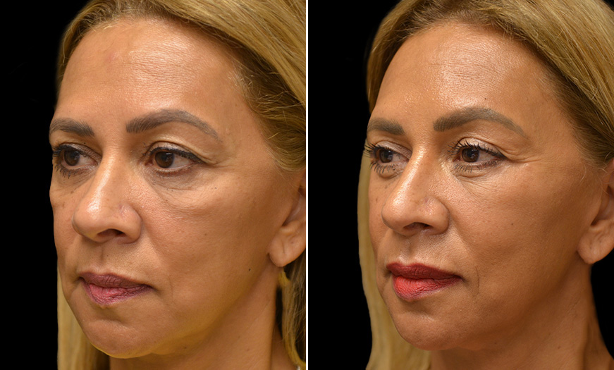 Festoon Correction And Facelift In New Jersey