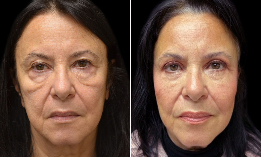 Eyelid Surgery, Festoon Correction, & Midface Lift Results