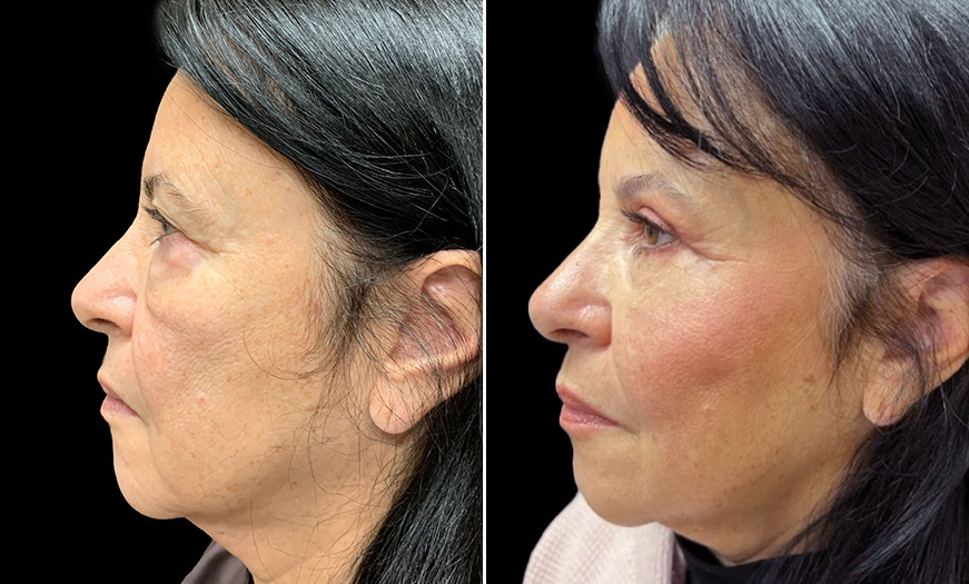 Eyelid Surgery, Festoon Correction, & Midface Lift Results NJ