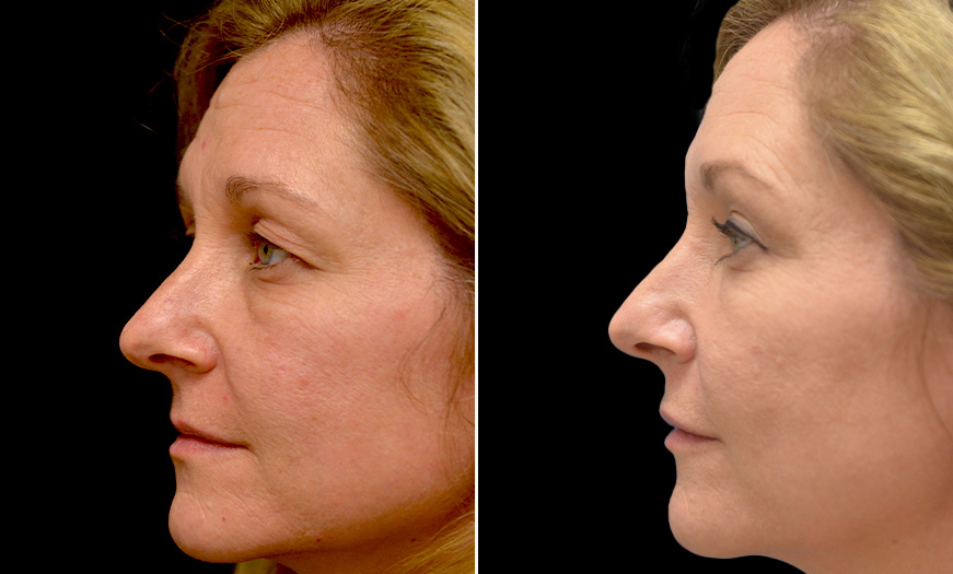 New Jersey Blepharoplasty Before & After Image