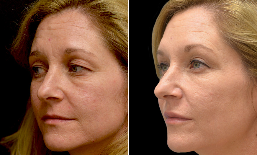 New Jersey Blepharoplasty Before & After Photo
