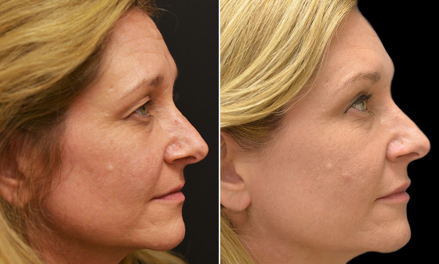 New Jersey Before & After Blepharoplasty Surgery
