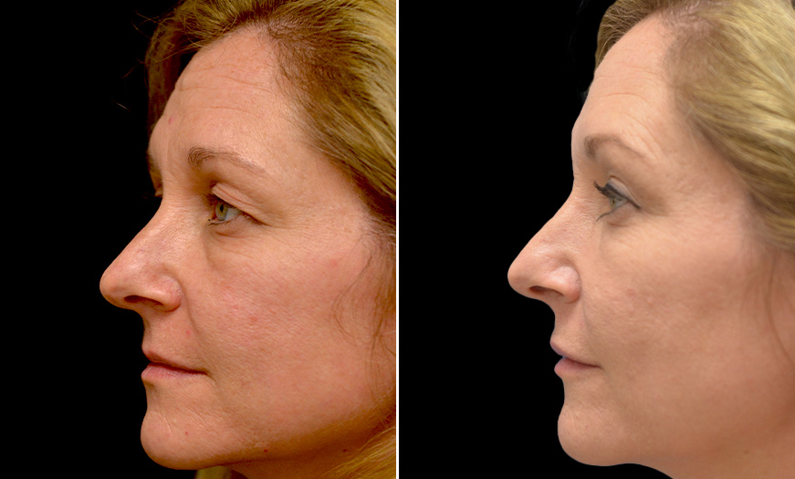 Botox Before And After In New Jersey