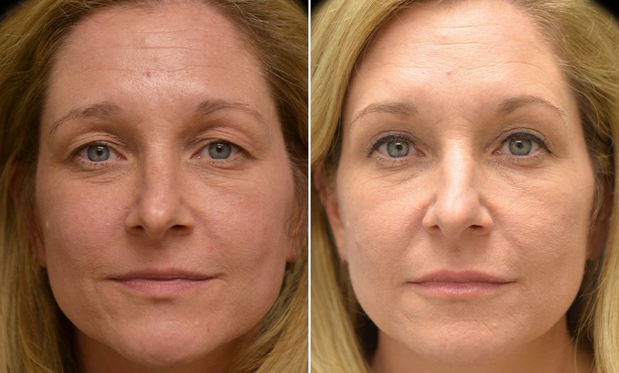 New Jersey Before And After Cosmetic Fillers In NJ