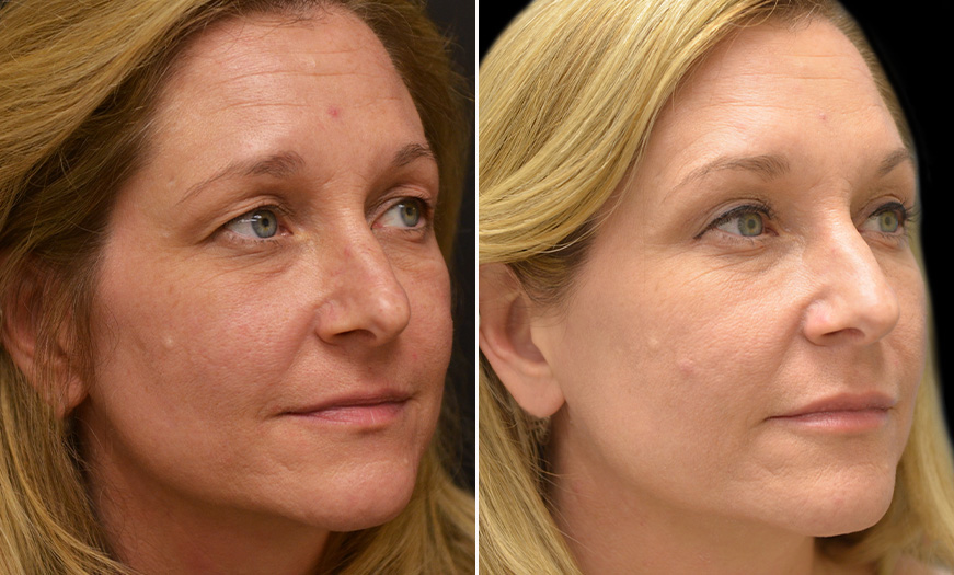 NJ Upper Blepharoplasty And Botox Fillers