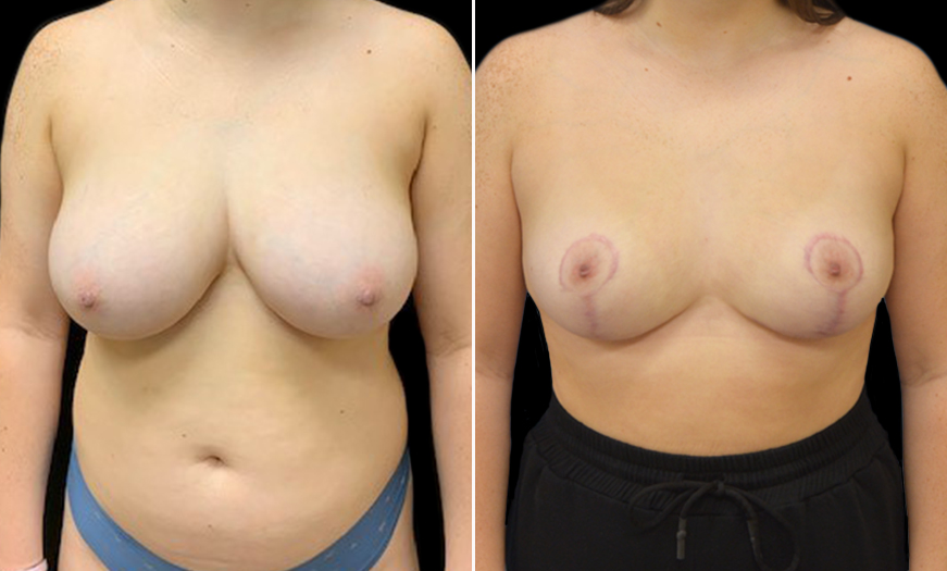 New Jersey Breast Reduction