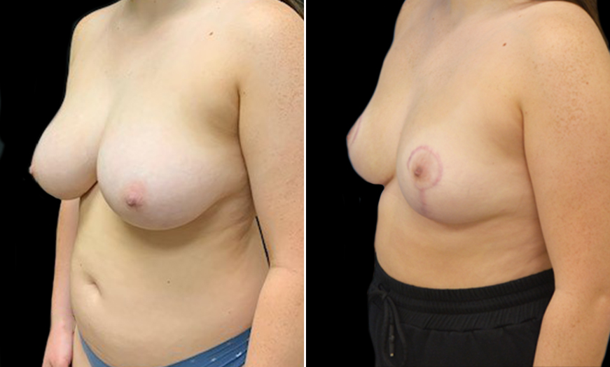 Breast Reduction New Jersey