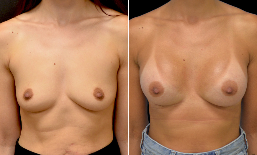 Before & After Breast Implants Treatment