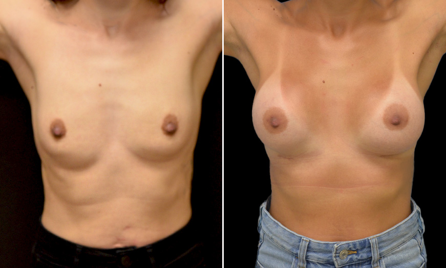 Before And After Breast Implants Treatment