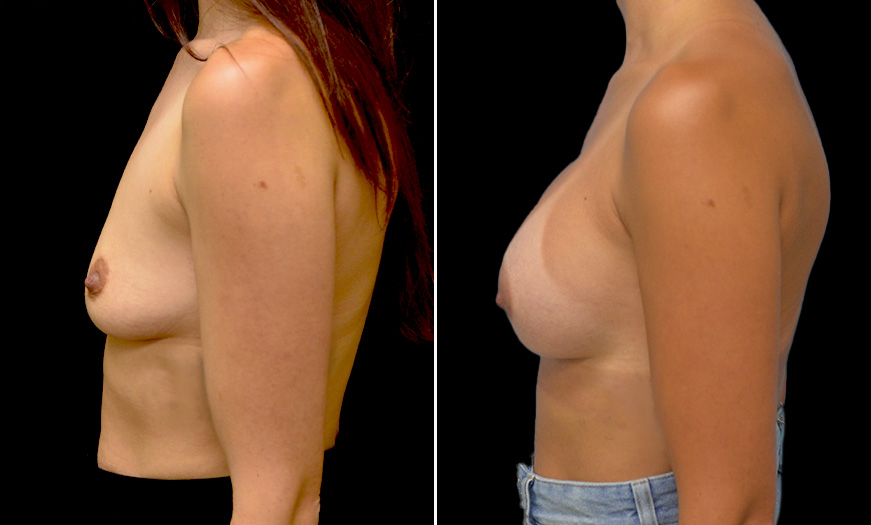 Breast Implants Treatment Before & After