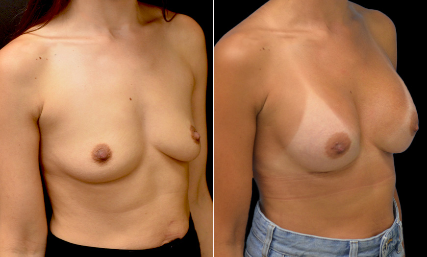 Breast Implants Surgery Results
