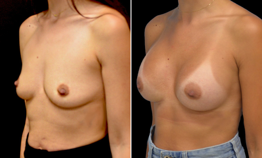 Breast Implants Treatment Before And After