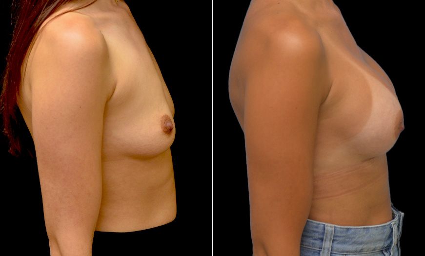 Before & After Breast Implants Surgery