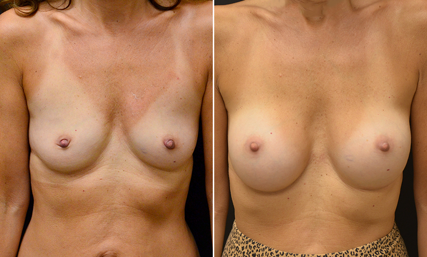 New Jersey Breast Implants Surgery Before & After