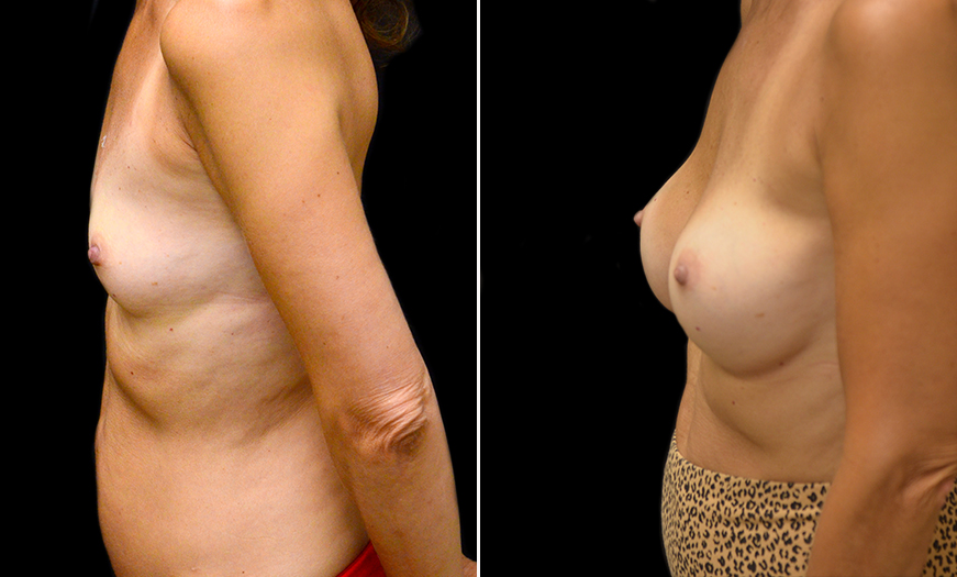 New Jersey Breast Implants Surgery Before And After