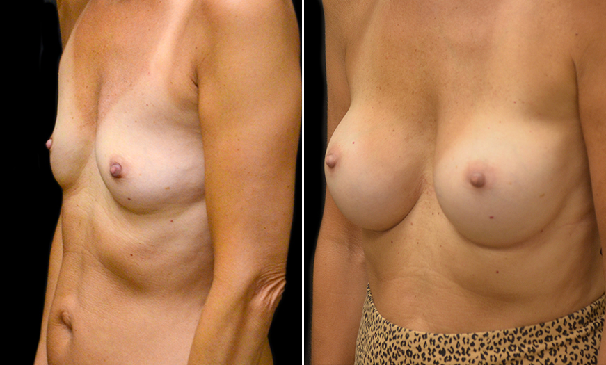 New Jersey Breast Implants Results