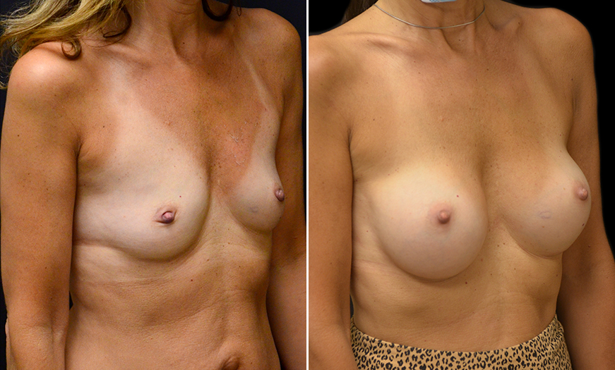 Before & After Breast Implants In New Jersey