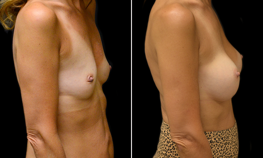 Before And After Breast Implants In New Jersey